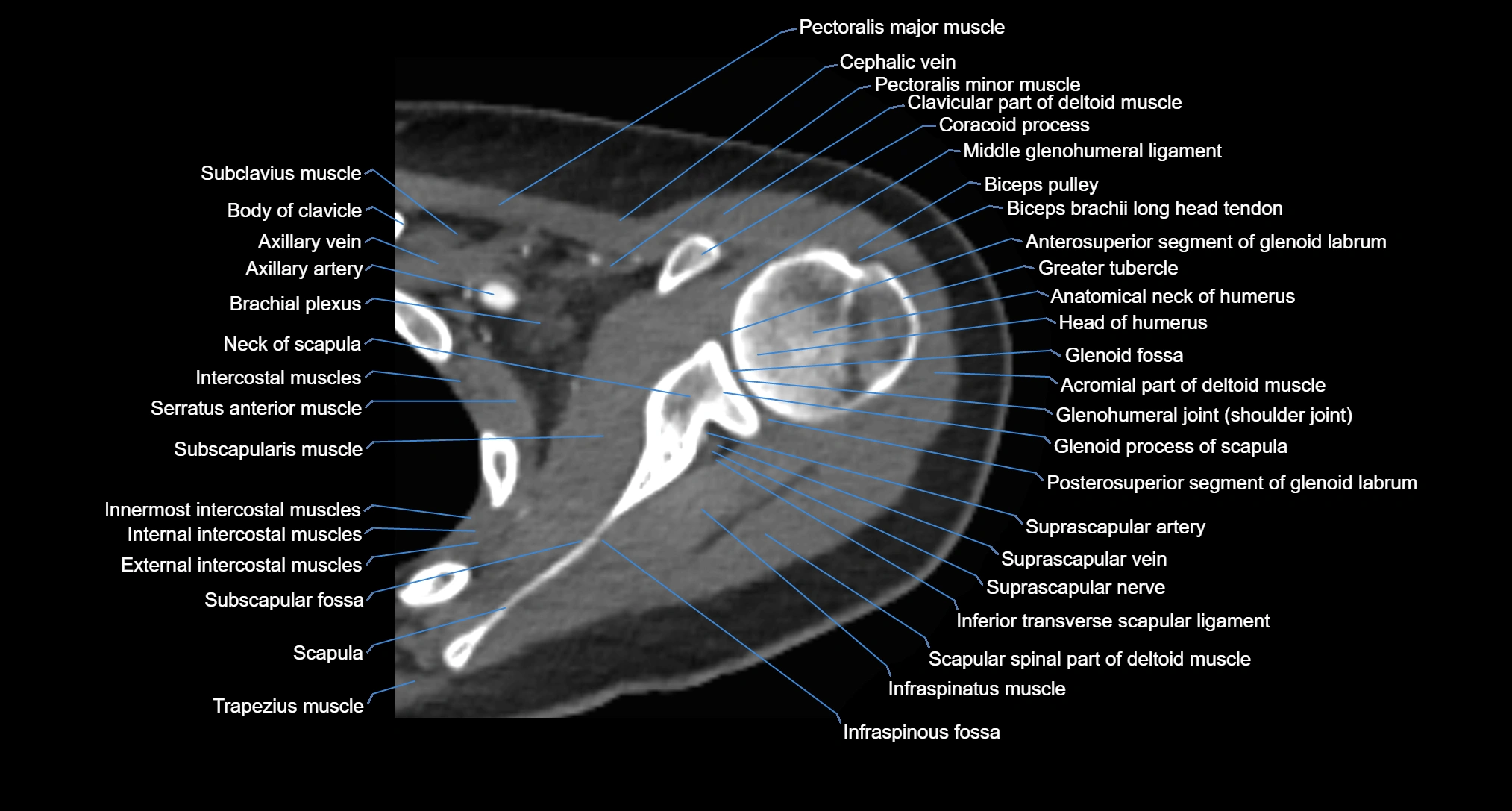 CT Shoulder axial cross sectional anatomy labelled radiology image -00029.webp